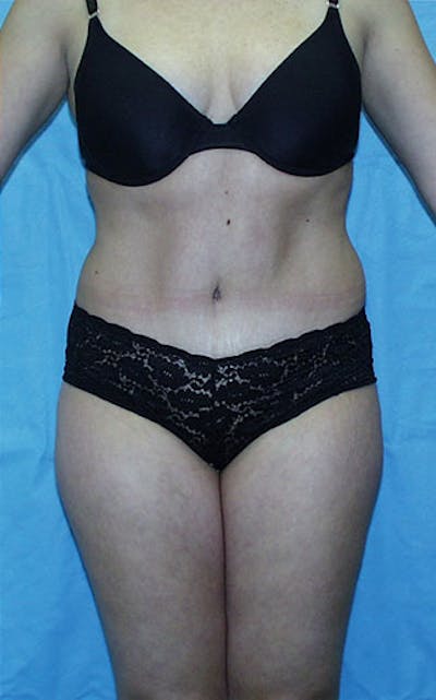 Tummy Tuck Before & After Gallery - Patient 23533866 - Image 2