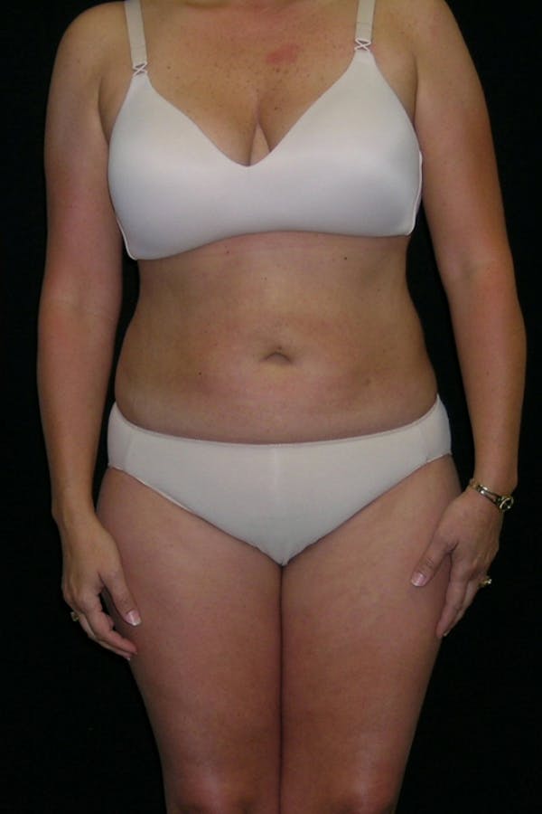Liposuction & SmartLipo Before & After Gallery - Patient 23533860 - Image 2