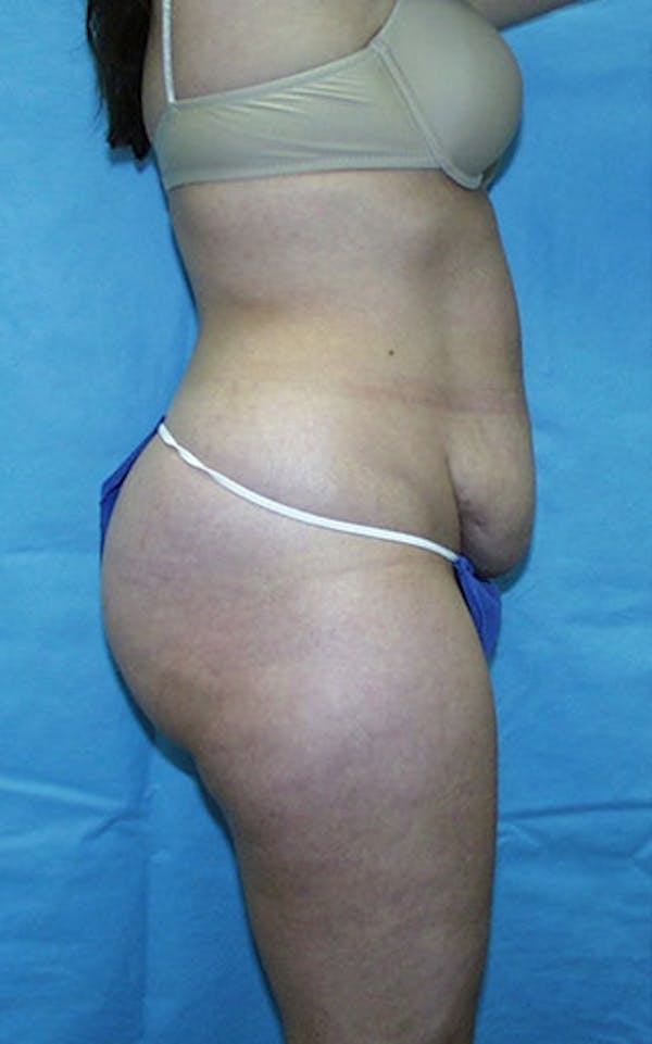 Tummy Tuck Before & After Gallery - Patient 23533866 - Image 3