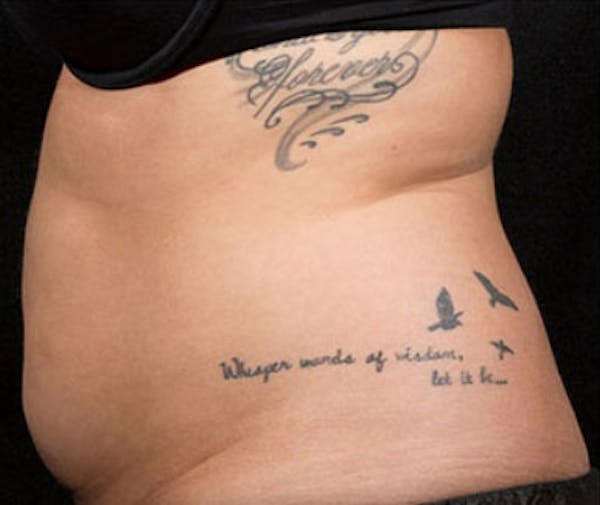 SculpSure Before & After Gallery - Patient 23533861 - Image 1