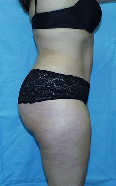 Tummy Tuck Before & After Gallery - Patient 23533866 - Image 4