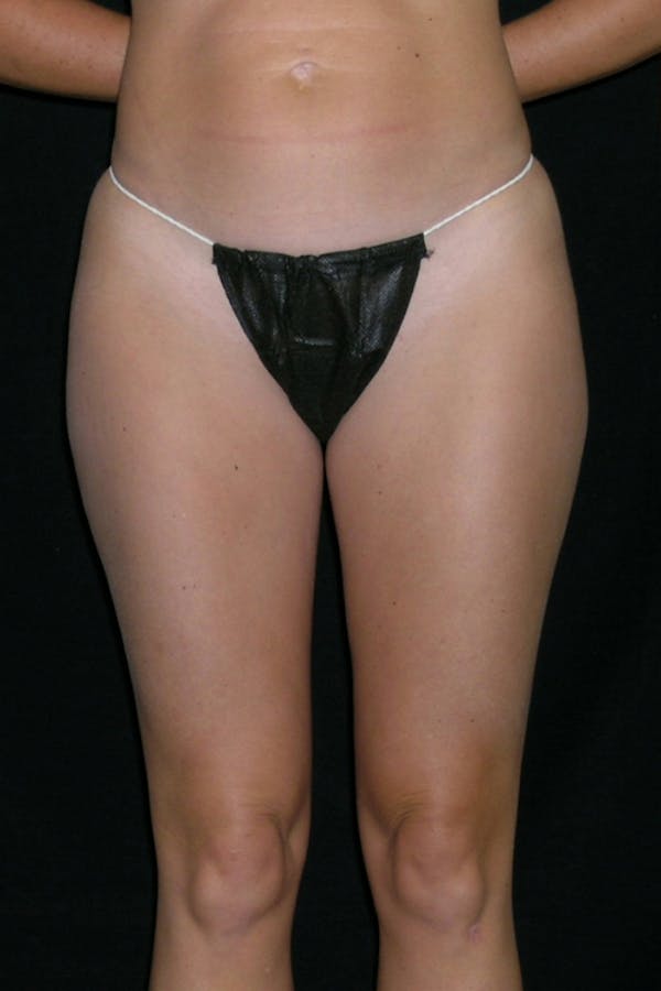 Liposuction & SmartLipo Before & After Gallery - Patient 23533868 - Image 1