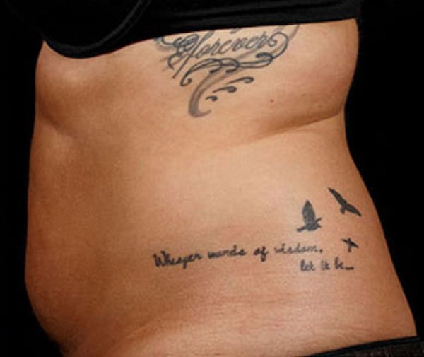 SculpSure Before & After Gallery - Patient 23533861 - Image 2