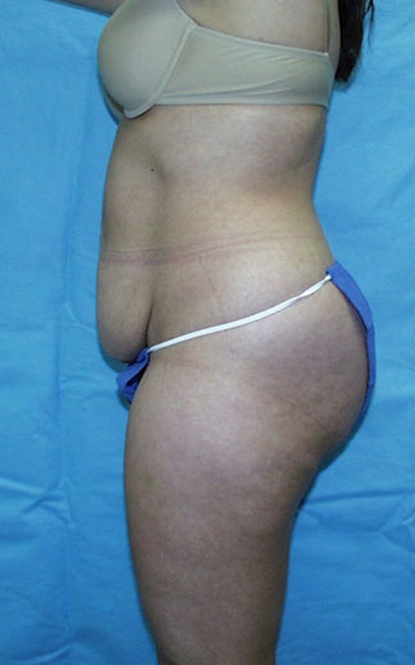 Tummy Tuck Before & After Gallery - Patient 23533866 - Image 5