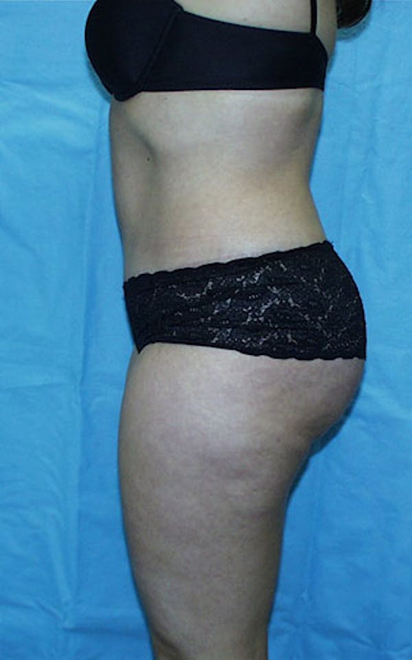 Tummy Tuck Before & After Gallery - Patient 23533866 - Image 6