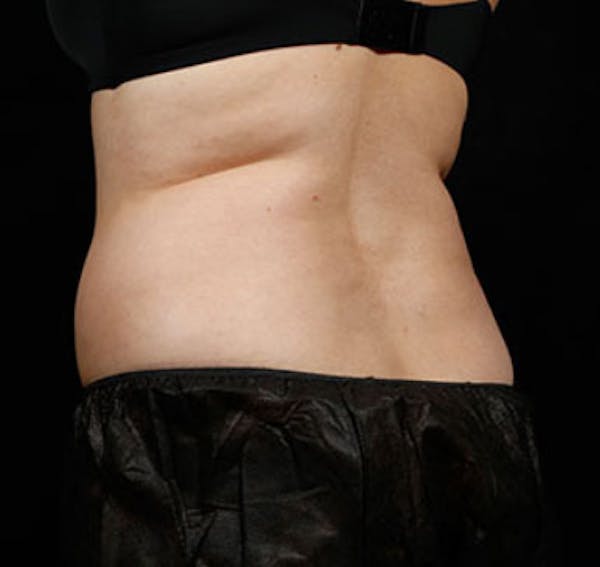 SculpSure Before & After Gallery - Patient 23533869 - Image 1