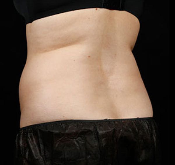 SculpSure Before & After Gallery - Patient 23533869 - Image 2