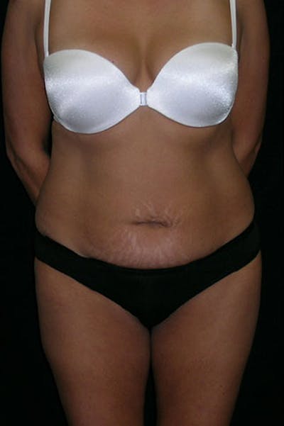 Tummy Tuck Before & After Gallery - Patient 23533876 - Image 1