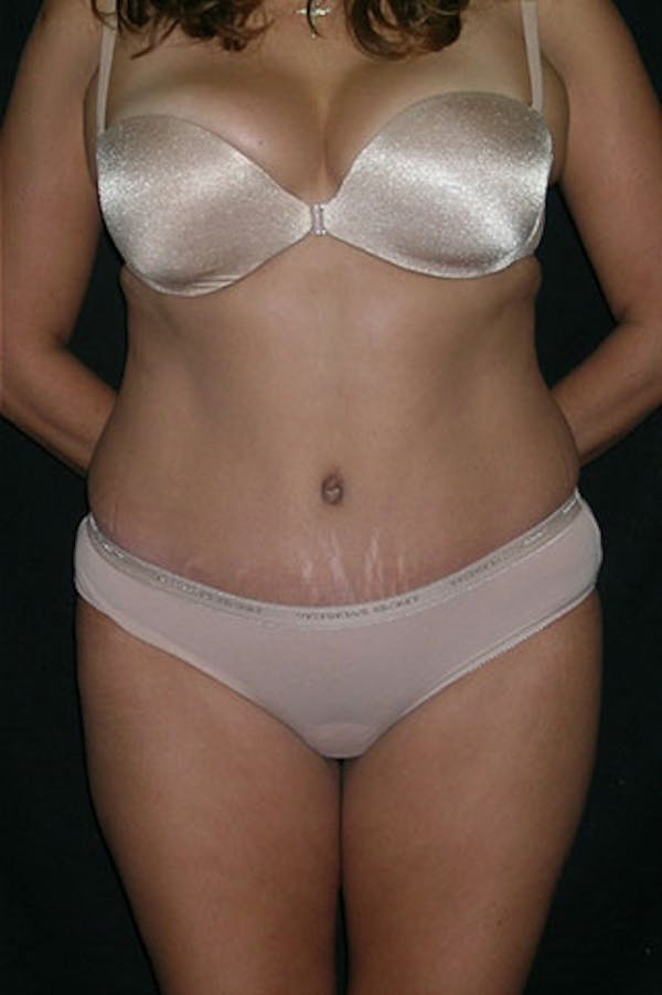 Tummy Tuck Before & After Gallery - Patient 23533876 - Image 2