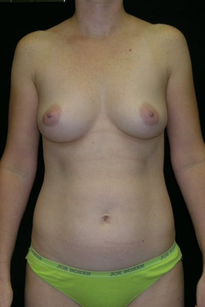 Liposuction & SmartLipo Before & After Gallery - Patient 23533874 - Image 1