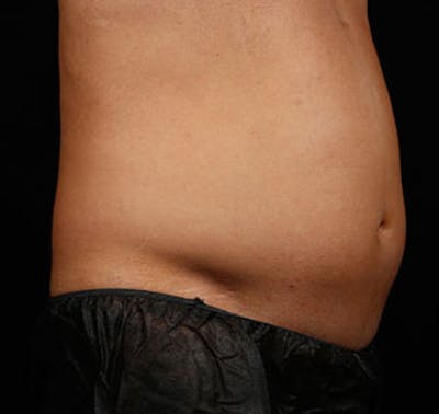SculpSure Before & After Gallery - Patient 23533873 - Image 1