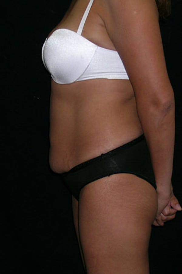Tummy Tuck Before & After Gallery - Patient 23533876 - Image 3