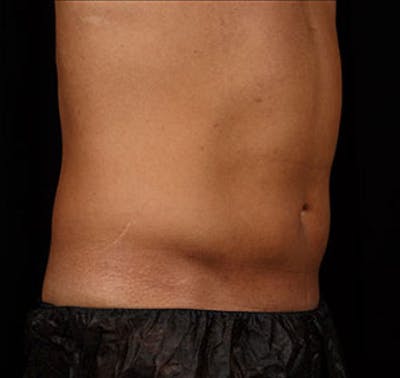 SculpSure Before & After Gallery - Patient 23533873 - Image 2