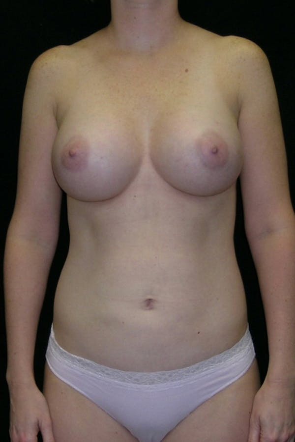 Liposuction & SmartLipo Before & After Gallery - Patient 23533874 - Image 2