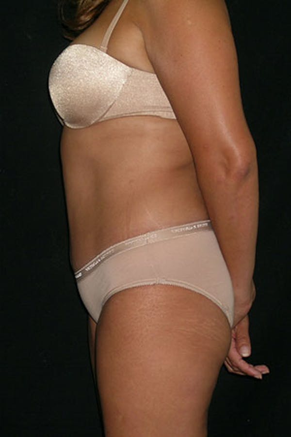 Tummy Tuck Before & After Gallery - Patient 23533876 - Image 4