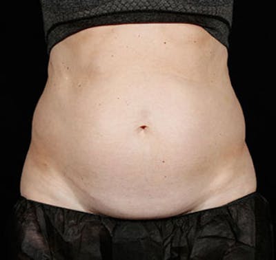 SculpSure Before & After Gallery - Patient 23533875 - Image 1