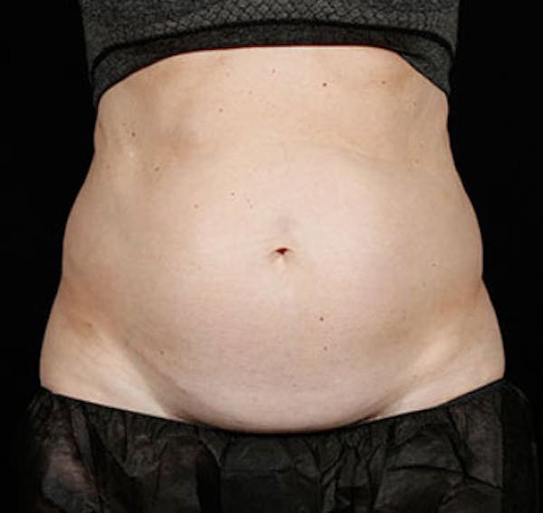 SculpSure Before & After Gallery - Patient 23533875 - Image 1