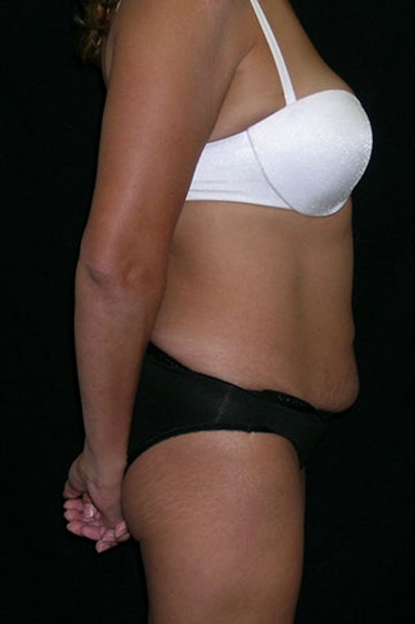Tummy Tuck Before & After Gallery - Patient 23533876 - Image 5