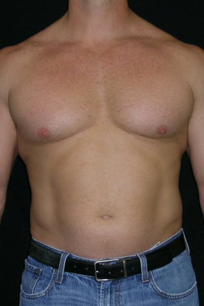 Liposuction & SmartLipo Before & After Gallery - Patient 23533877 - Image 1