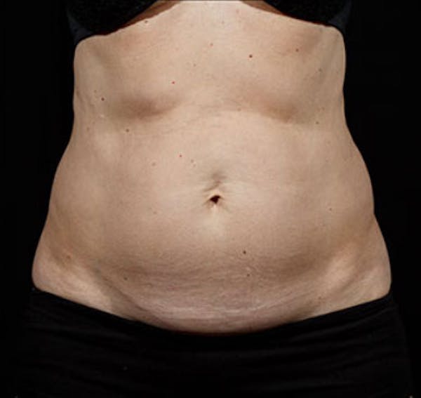 SculpSure Before & After Gallery - Patient 23533875 - Image 2