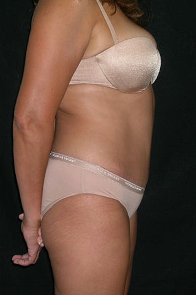 Tummy Tuck Before & After Gallery - Patient 23533876 - Image 6