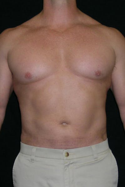 Liposuction & SmartLipo Before & After Gallery - Patient 23533877 - Image 2