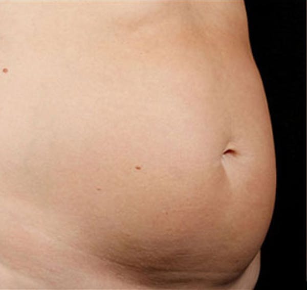 SculpSure Before & After Gallery - Patient 23533878 - Image 1