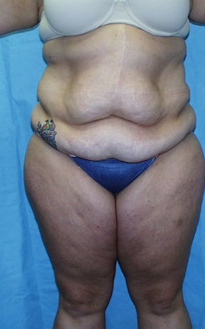 Tummy Tuck Before & After Gallery - Patient 23533882 - Image 1