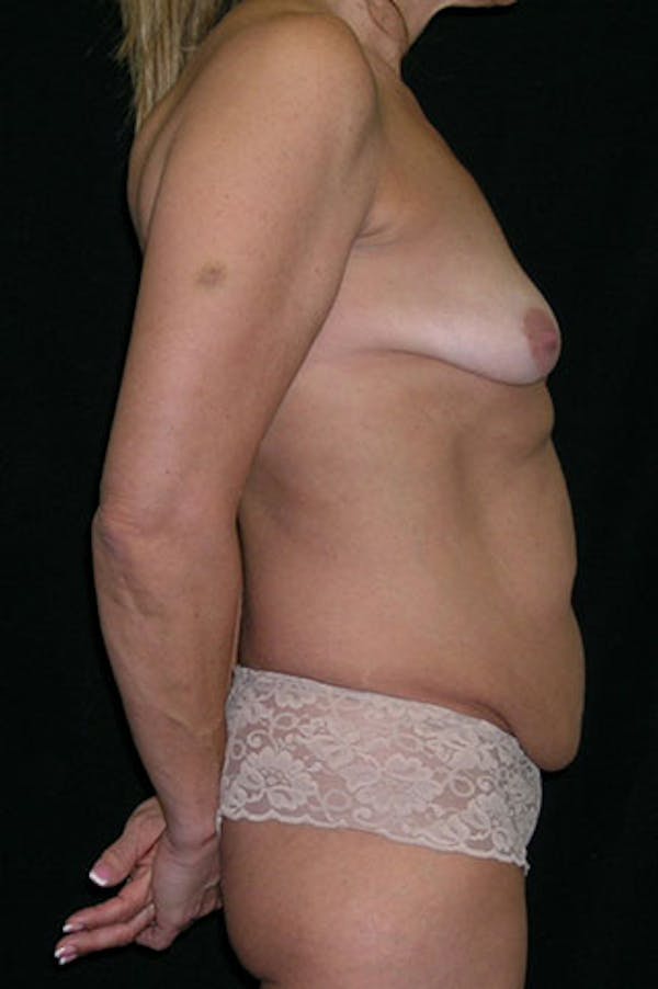 Mommy Makeover Before & After Gallery - Patient 23533879 - Image 7
