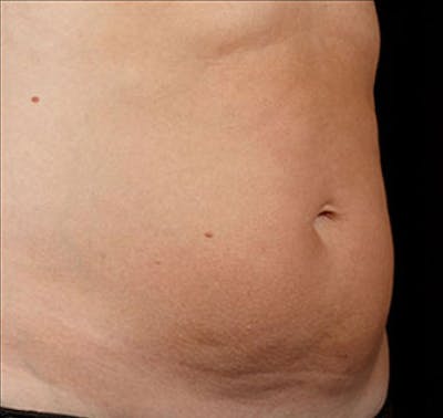 SculpSure Before & After Gallery - Patient 23533878 - Image 2