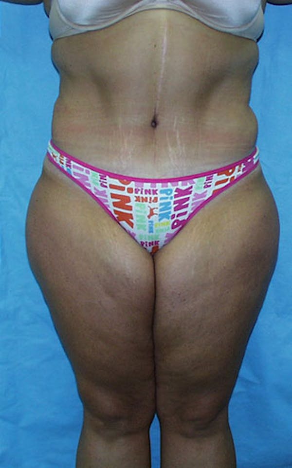 Tummy Tuck Before & After Gallery - Patient 23533882 - Image 2