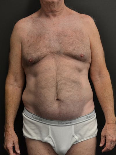 Liposuction & SmartLipo Before & After Gallery - Patient 23533888 - Image 1