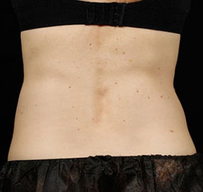 SculpSure Before & After Gallery - Patient 23533880 - Image 1