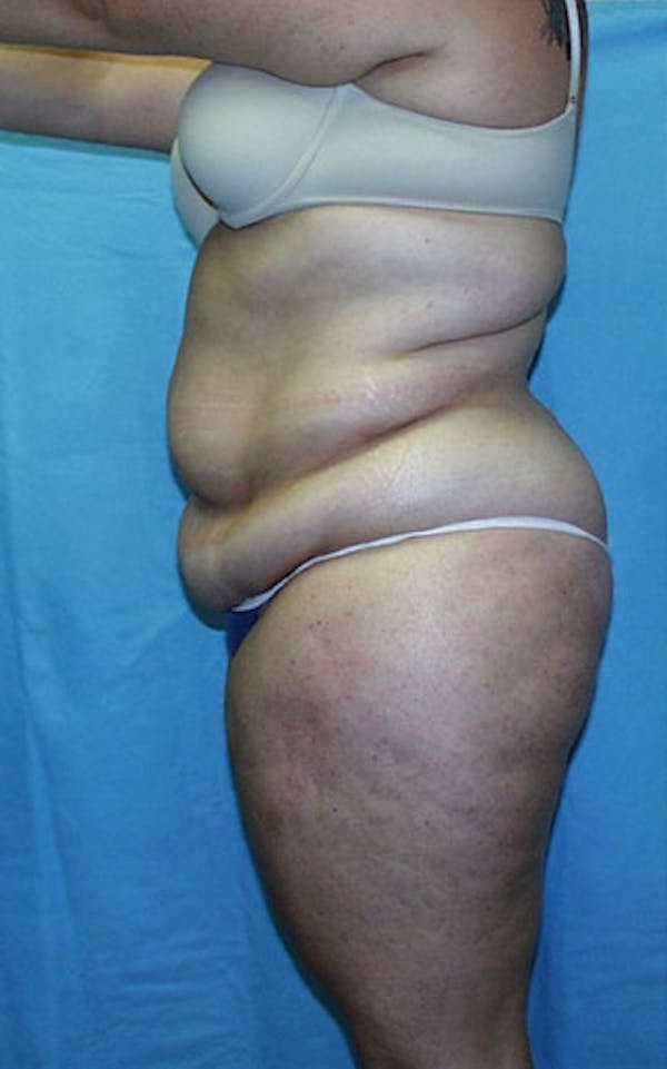 Tummy Tuck Before & After Gallery - Patient 23533882 - Image 3