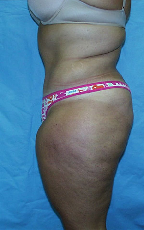 Tummy Tuck Gallery - Patient 23533882 - Image 4