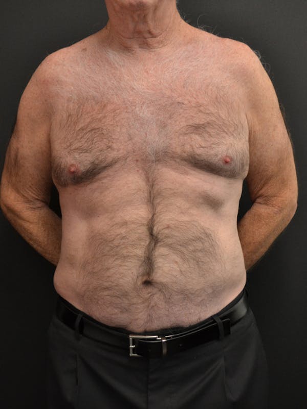 Liposuction & SmartLipo Before & After Gallery - Patient 23533888 - Image 2