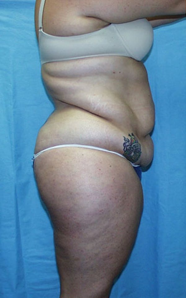 Tummy Tuck Before & After Gallery - Patient 23533882 - Image 5