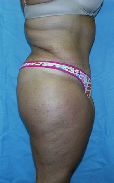 Tummy Tuck Before & After Gallery - Patient 23533882 - Image 6