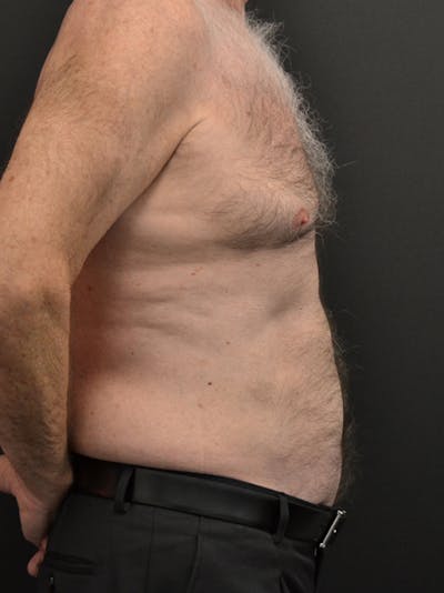 Liposuction & SmartLipo Before & After Gallery - Patient 23533888 - Image 4