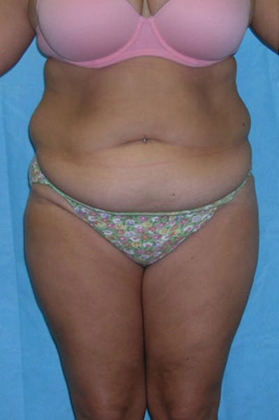 Tummy Tuck Before & After Gallery - Patient 23533889 - Image 1