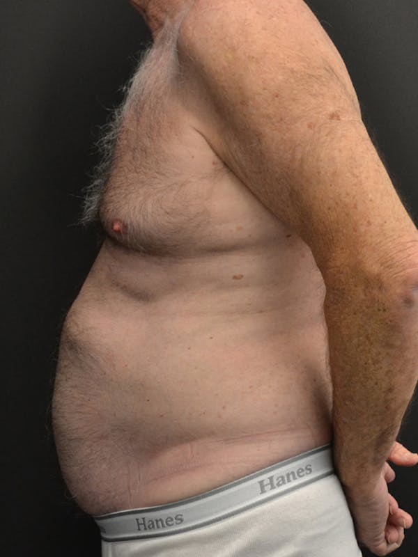 Liposuction & SmartLipo Before & After Gallery - Patient 23533888 - Image 5