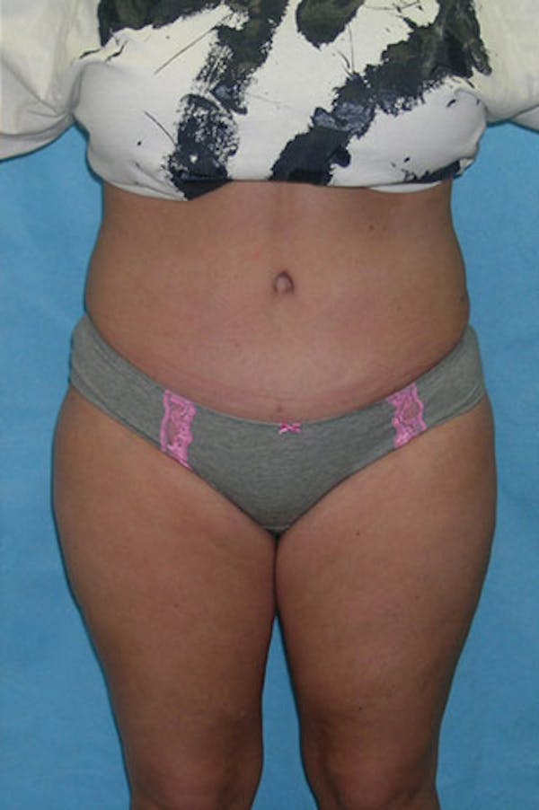 Tummy Tuck Before & After Gallery - Patient 23533889 - Image 2