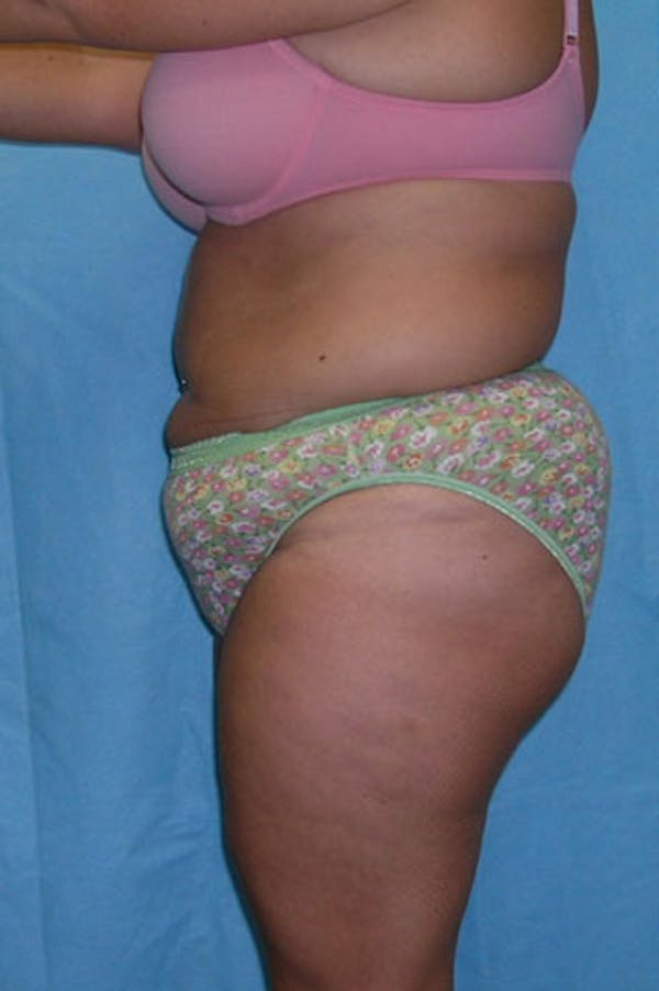Tummy Tuck Before & After Gallery - Patient 23533889 - Image 3