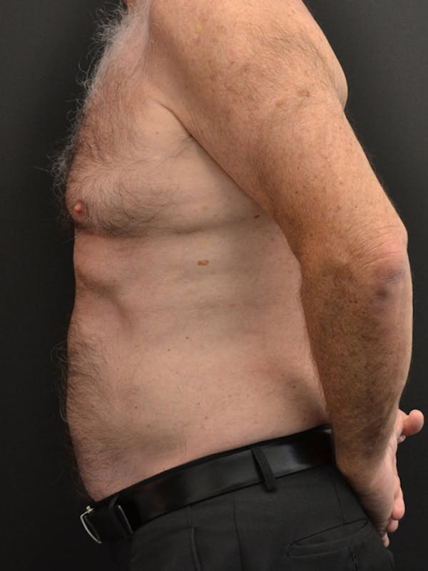 Liposuction & SmartLipo Before & After Gallery - Patient 23533888 - Image 6