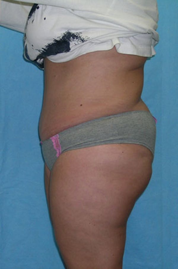 Tummy Tuck Before & After Gallery - Patient 23533889 - Image 4