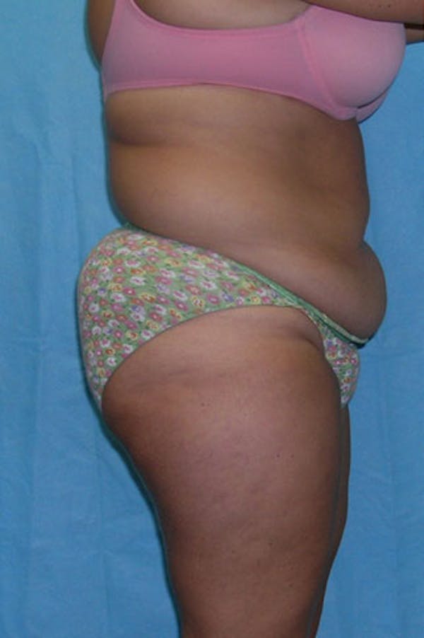 Tummy Tuck Before & After Gallery - Patient 23533889 - Image 5
