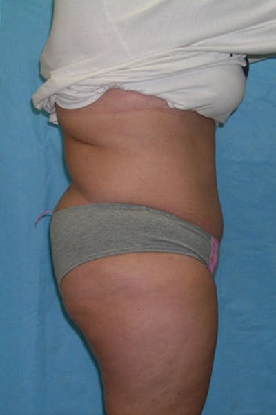 Tummy Tuck Before & After Gallery - Patient 23533889 - Image 6