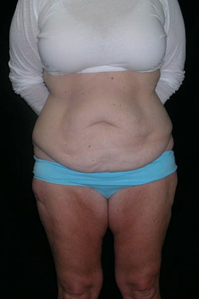 Tummy Tuck Before & After Gallery - Patient 23533893 - Image 1