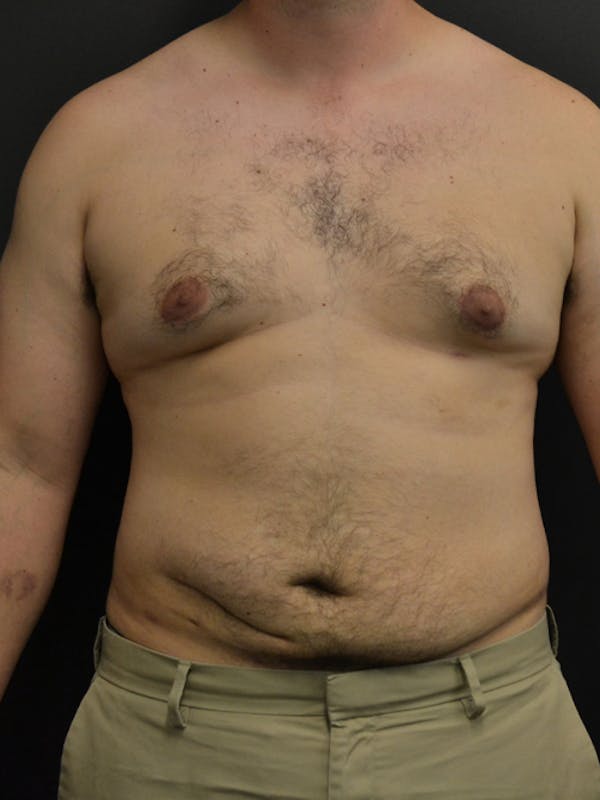 Liposuction & SmartLipo Before & After Gallery - Patient 23533892 - Image 2