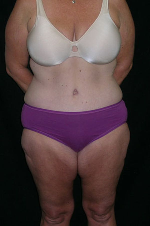 Tummy Tuck Before & After Gallery - Patient 23533893 - Image 2